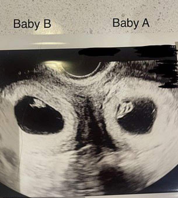 000万分之1机率！女子「双子宫同时怀孕」奇蹟生下双胞胎：一个持续跟踪报道"